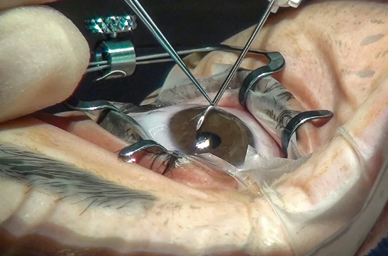 Cataract Surgery for Infants and Children